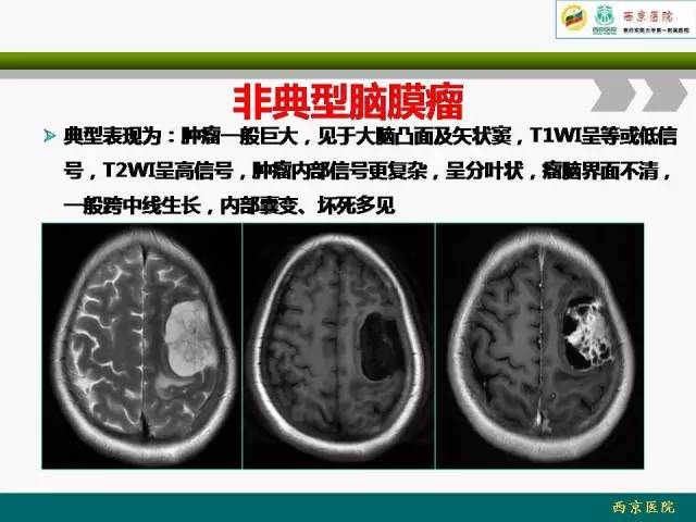 【病例】脑膜瘤VS血管周细胞瘤MR影像表现