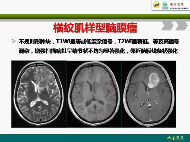 【病例】脑膜瘤VS血管周细胞瘤MR影像表现