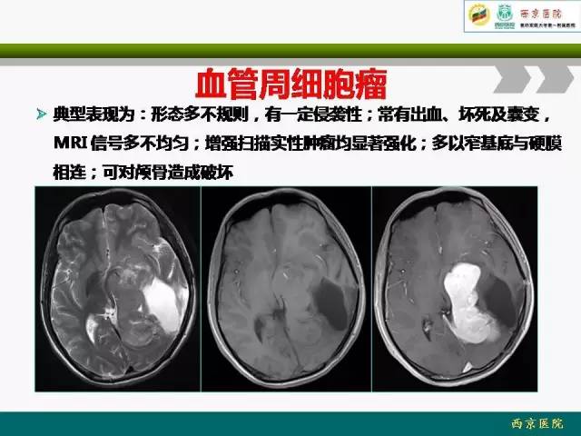 【病例】脑膜瘤VS血管周细胞瘤MR影像表现