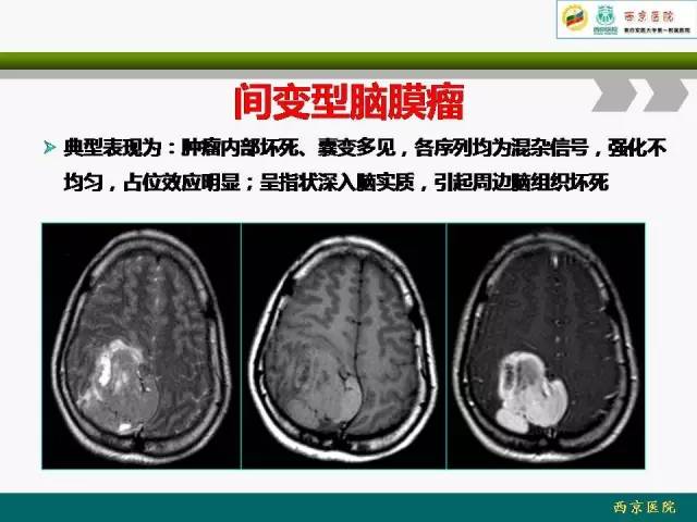 【病例】脑膜瘤VS血管周细胞瘤MR影像表现