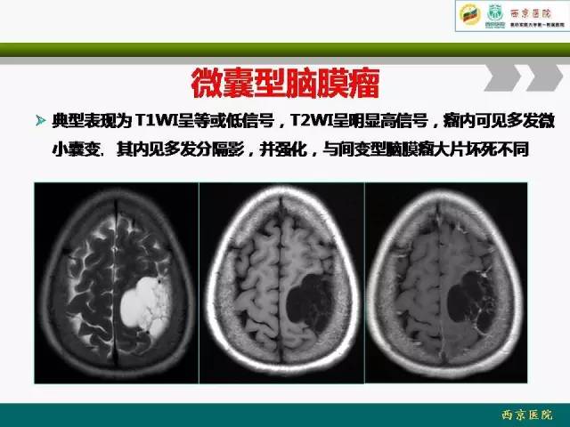 【病例】脑膜瘤VS血管周细胞瘤MR影像表现
