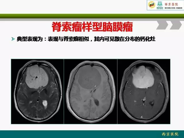 【病例】脑膜瘤VS血管周细胞瘤MR影像表现