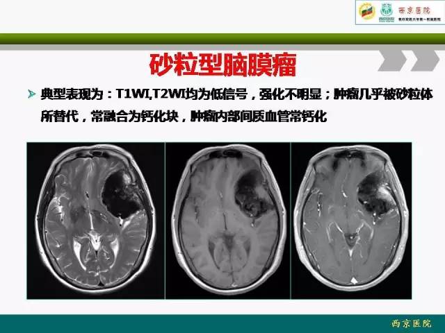 【病例】脑膜瘤VS血管周细胞瘤MR影像表现