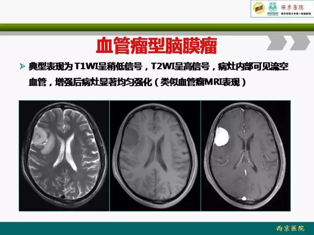 【病例】脑膜瘤VS血管周细胞瘤MR影像表现