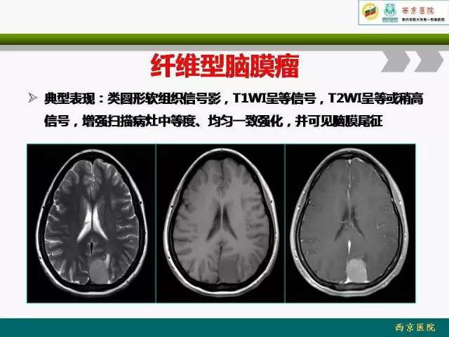 【病例】脑膜瘤VS血管周细胞瘤MR影像表现