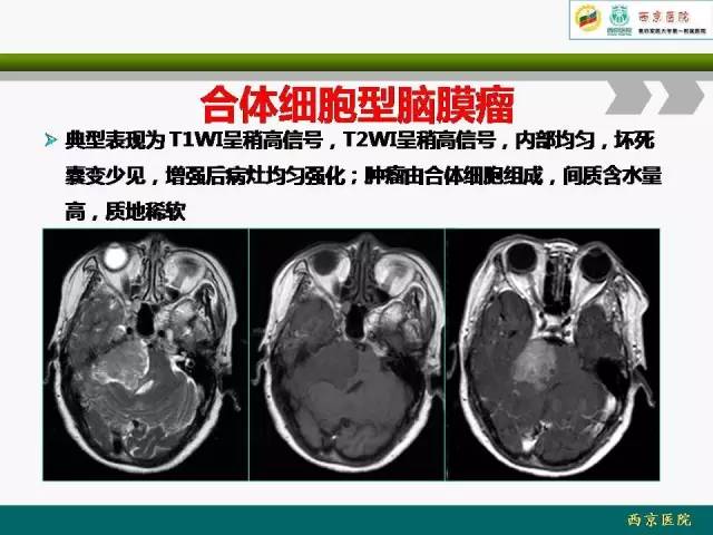 【病例】脑膜瘤VS血管周细胞瘤MR影像表现