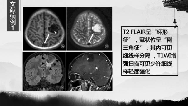 【病例】胚胎发育不良性神经上皮瘤DNET一例CT及MR表现与鉴别 【病例】胚胎发育不良性神经上皮瘤DNET一例CT及MR表现与鉴别