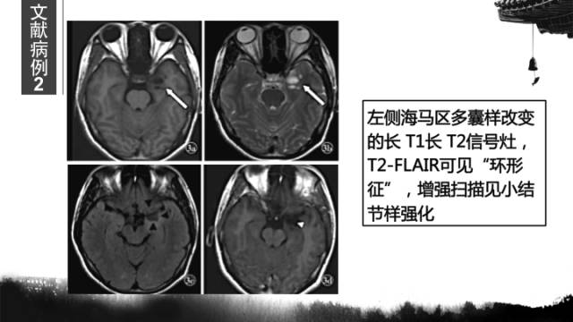 【病例】胚胎发育不良性神经上皮瘤DNET一例CT及MR表现与鉴别 【病例】胚胎发育不良性神经上皮瘤DNET一例CT及MR表现与鉴别