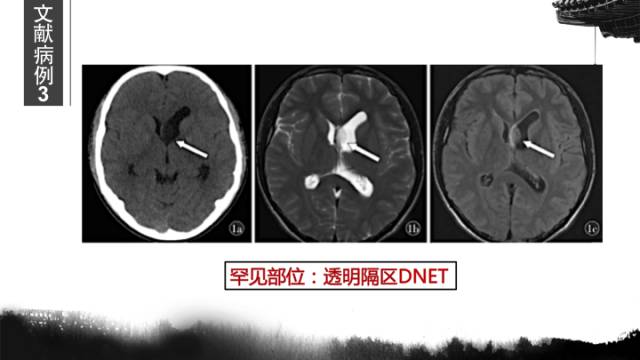 【病例】胚胎发育不良性神经上皮瘤DNET一例CT及MR表现与鉴别 【病例】胚胎发育不良性神经上皮瘤DNET一例CT及MR表现与鉴别