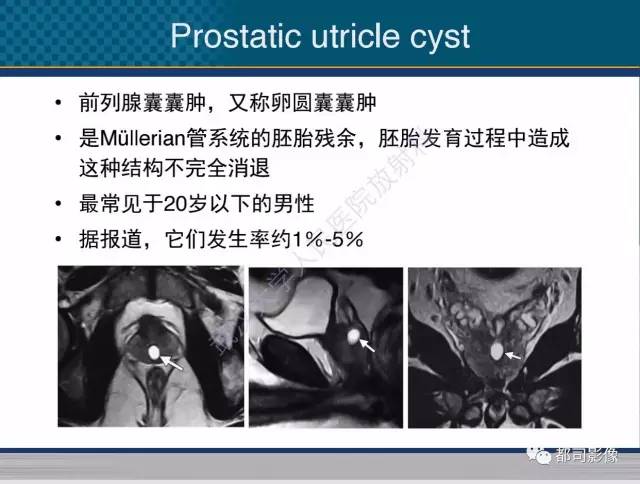 【PPT】男性下泌尿生殖道囊肿影像学鉴别诊断