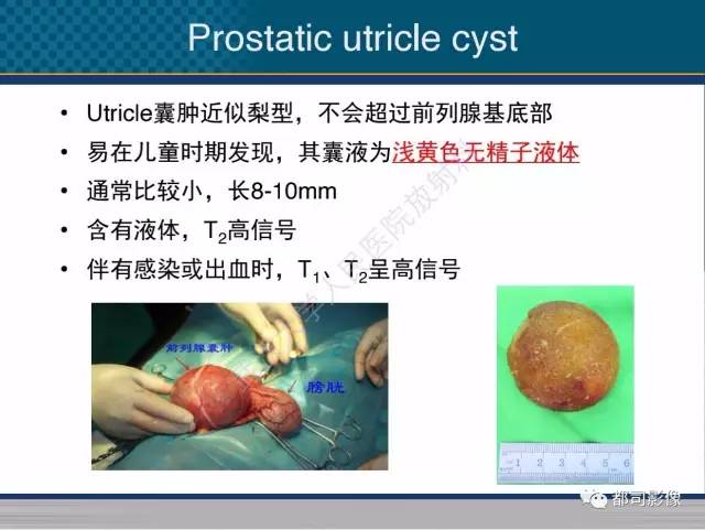 【PPT】男性下泌尿生殖道囊肿影像学鉴别诊断