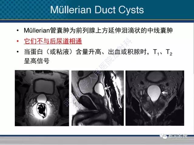 【PPT】男性下泌尿生殖道囊肿影像学鉴别诊断