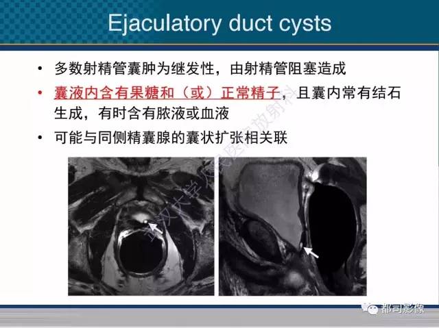 【PPT】男性下泌尿生殖道囊肿影像学鉴别诊断