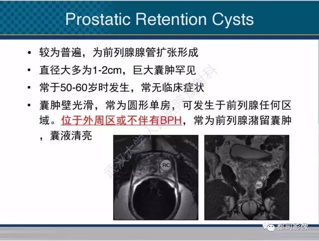 【PPT】男性下泌尿生殖道囊肿影像学鉴别诊断