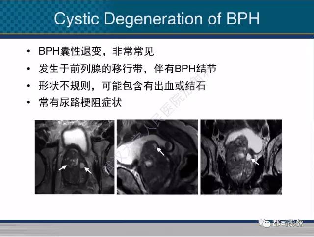 【PPT】男性下泌尿生殖道囊肿影像学鉴别诊断