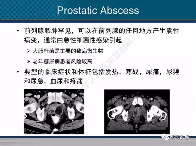 【PPT】男性下泌尿生殖道囊肿影像学鉴别诊断