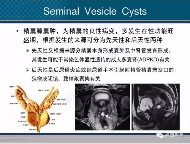 【PPT】男性下泌尿生殖道囊肿影像学鉴别诊断