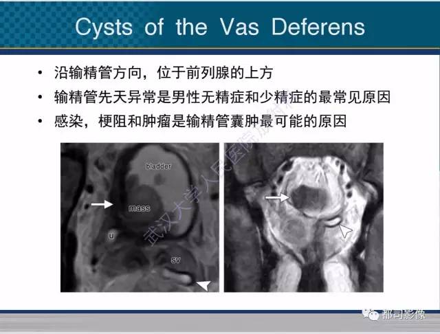 【PPT】男性下泌尿生殖道囊肿影像学鉴别诊断