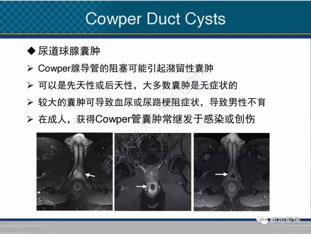【PPT】男性下泌尿生殖道囊肿影像学鉴别诊断