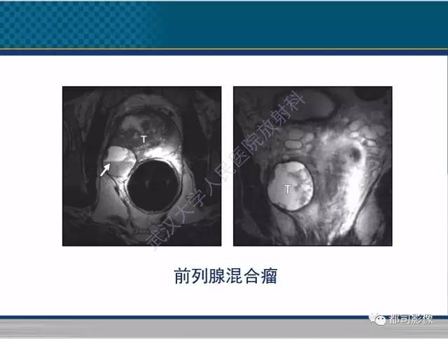 【PPT】男性下泌尿生殖道囊肿影像学鉴别诊断