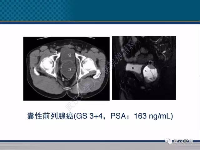 【PPT】男性下泌尿生殖道囊肿影像学鉴别诊断