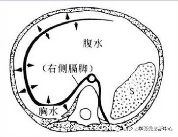四个征象告诉你如何鉴别胸腹水