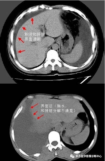 四个征象告诉你如何鉴别胸腹水
