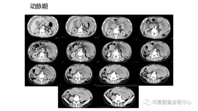 【病例】腹内疝并绞窄性肠梗阻1例CT