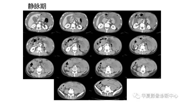 【病例】腹内疝并绞窄性肠梗阻1例CT
