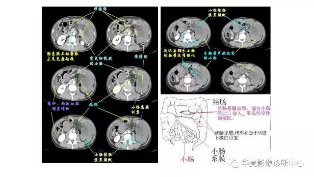 【病例】腹内疝并绞窄性肠梗阻1例CT