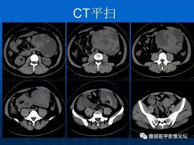 【病例】卵巢支持间质细胞肿瘤1例CT影像表现