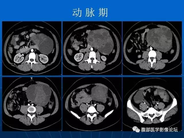 【病例】卵巢支持间质细胞肿瘤1例CT影像表现