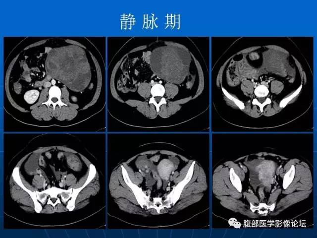 【病例】卵巢支持间质细胞肿瘤1例CT影像表现
