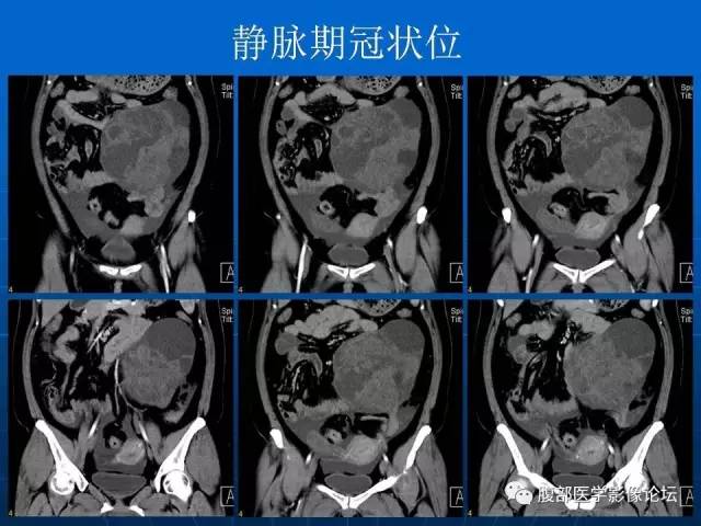 【病例】卵巢支持间质细胞肿瘤1例CT影像表现