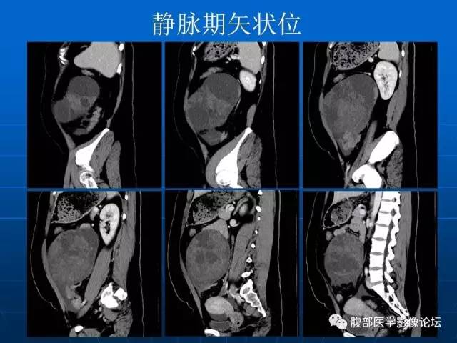 【病例】卵巢支持间质细胞肿瘤1例CT影像表现