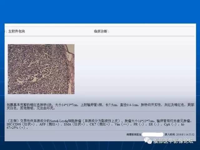 【病例】卵巢支持间质细胞肿瘤1例CT影像表现