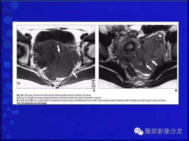 【病例】卵巢支持间质细胞肿瘤1例CT影像表现