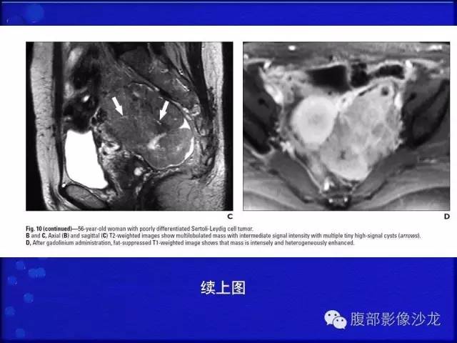 【病例】卵巢支持间质细胞肿瘤1例CT影像表现