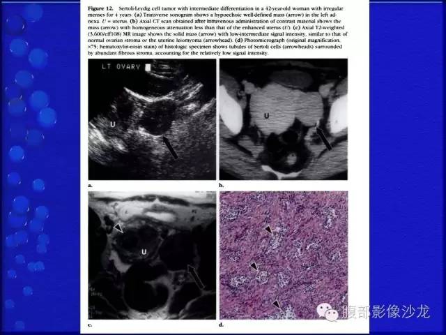 【病例】卵巢支持间质细胞肿瘤1例CT影像表现