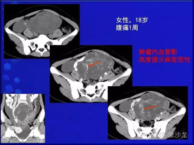【病例】卵巢支持间质细胞肿瘤1例CT影像表现