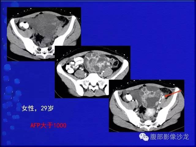 【病例】卵巢支持间质细胞肿瘤1例CT影像表现