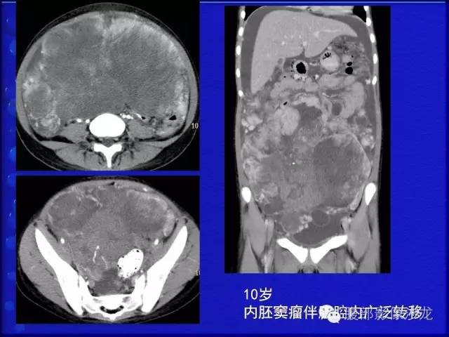 【病例】卵巢支持间质细胞肿瘤1例CT影像表现