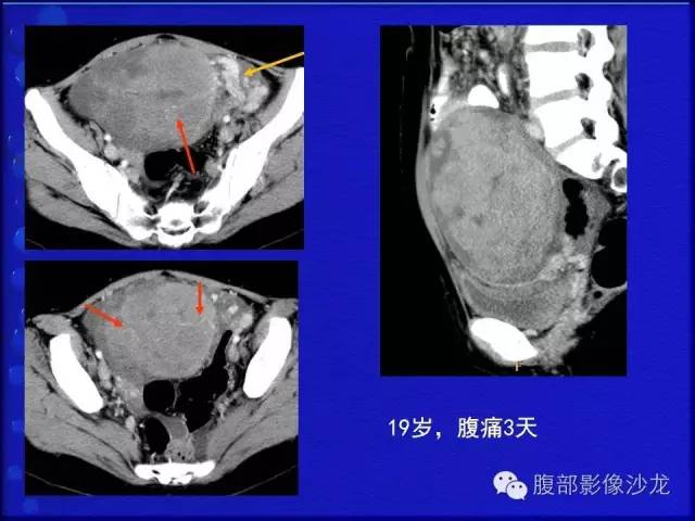 【病例】卵巢支持间质细胞肿瘤1例CT影像表现
