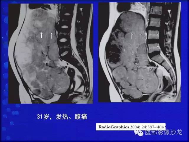 【病例】卵巢支持间质细胞肿瘤1例CT影像表现