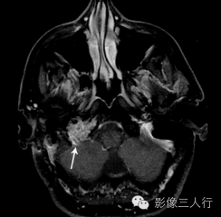 "盐和胡椒征"，这个征象提示啥？