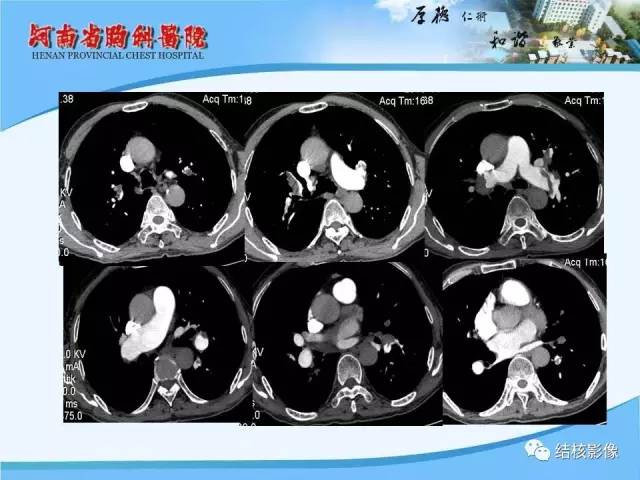 【PPT】胸痛相关疾病的影像诊断