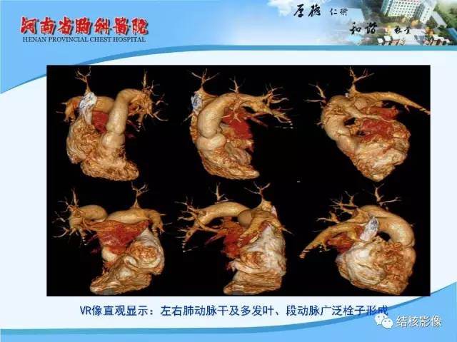 【PPT】胸痛相关疾病的影像诊断