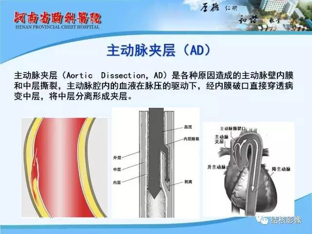 【PPT】胸痛相关疾病的影像诊断