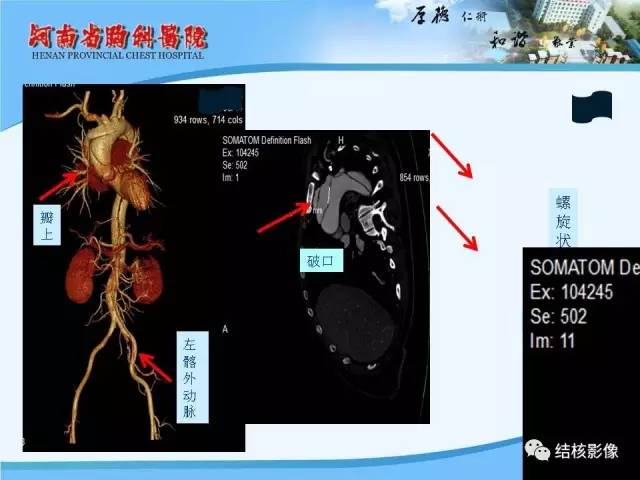 【PPT】胸痛相关疾病的影像诊断