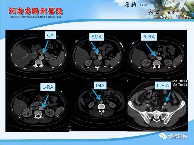 【PPT】胸痛相关疾病的影像诊断